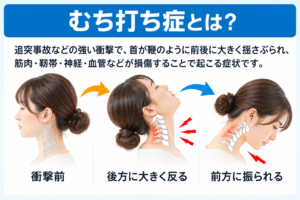 追突事故によるむち打ち症で首が前後に大きく動く仕組みを解説した画像